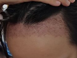 -新生植发·植养护一体