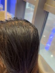 -碧莲盛·不剃发植发