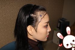 点击看大图 -大麦微针植发丨全国连锁