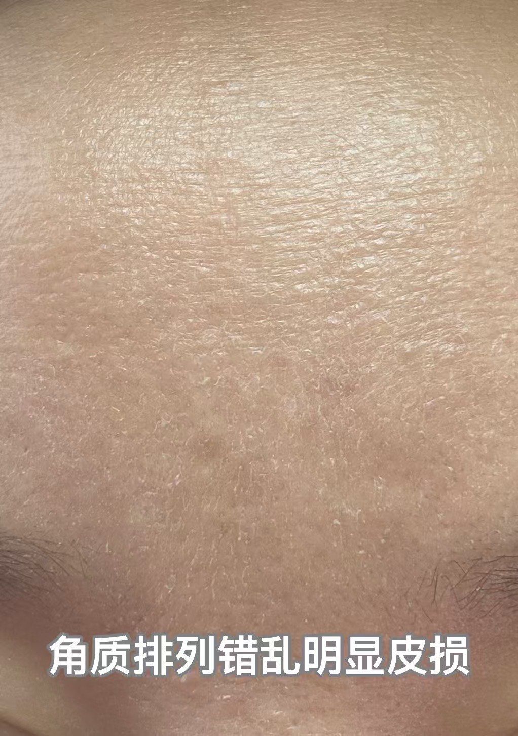 图一皮肤表面不是立体的粗糙,说明角质排列