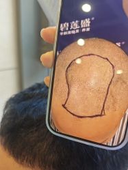 -碧莲盛·不剃发植发