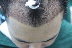 点击看大图 -大麦微针植发丨全国连锁