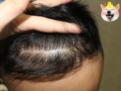 -大麦微针植发丨全国连锁