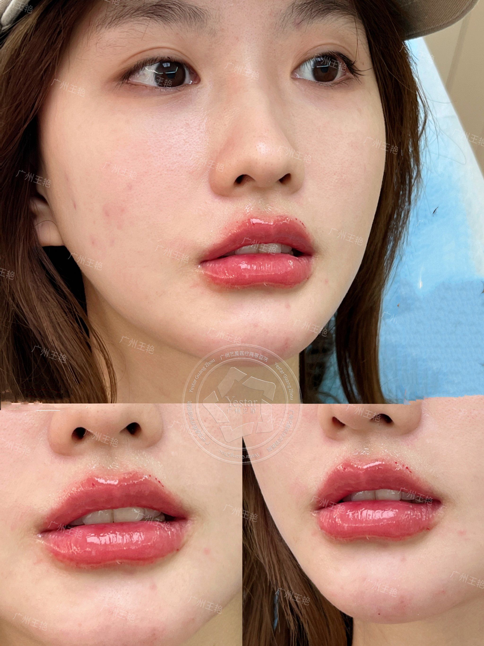 果冻唇➕口周年轻化