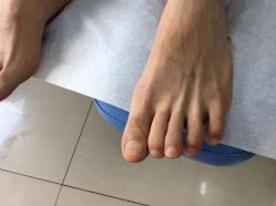 -德哥灰指甲脚气甲沟炎跖疣护理