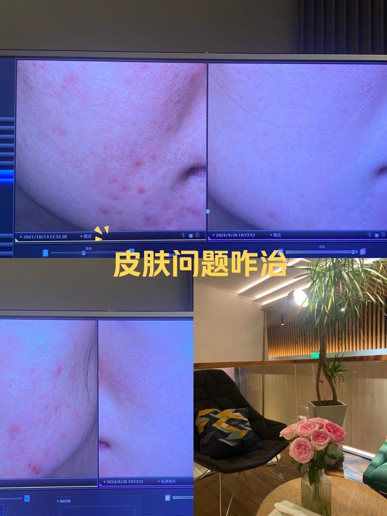 痘痘变好的过程