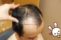 -大麦微针植发丨全国连锁