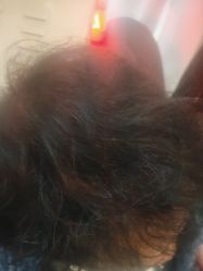 -碧莲盛·不剃发植发