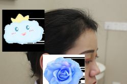 -大麦微针植发丨全国连锁