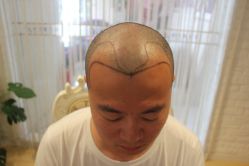 点击看大图 -大麦微针植发丨全国连锁