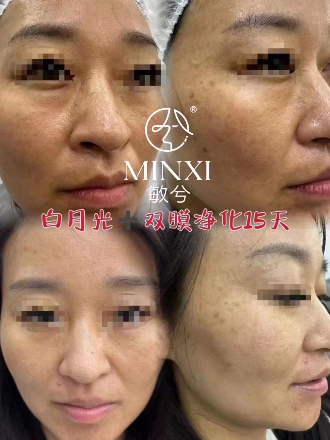 99 产品效果分享98
 [白月光] 77 [双膜净化]
*坚持使用15