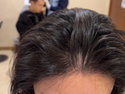 -碧莲盛·不剃发植发