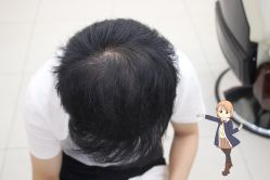 -大麦微针植发丨全国连锁