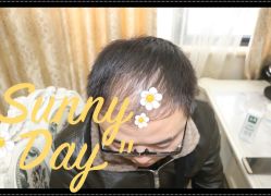 -大麦微针植发全国连锁