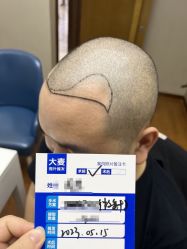 -大麦微针植发全国连锁