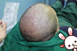 -大麦微针植发丨全国连锁