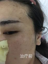 -爱莎扁平疣·汗管瘤·斑痣中心