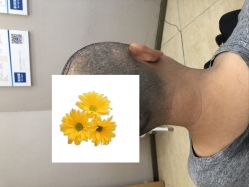 -大麦微针植发丨全国连锁