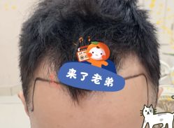 -大麦微针植发全国连锁