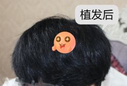 -大麦微针植发全国连锁