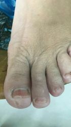 点击看大图 -德哥灰指甲脚气甲沟炎跖疣护理