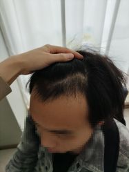 -大麦微针植发丨全国连锁