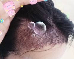 -大麦微针植发全国连锁