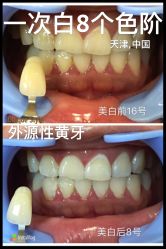 光SPA牙齿美白-光SPA科技美肤