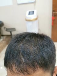 -碧莲盛·不剃发植发