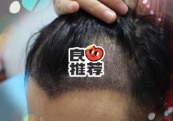 -大麦微针植发全国连锁