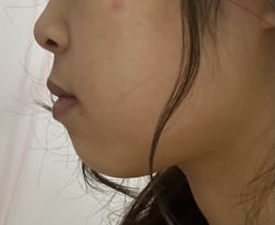 点击看大图 体验后-广州美莱医疗美容医院