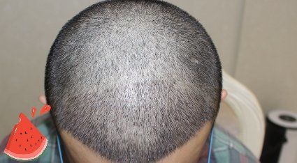 -大麦微针植发丨全国连锁