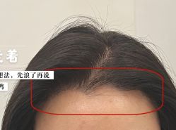 -大麦微针植发全国连锁