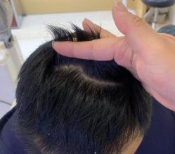 -大麦微针植发全国连锁