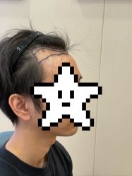 -大麦微针植发全国连锁
