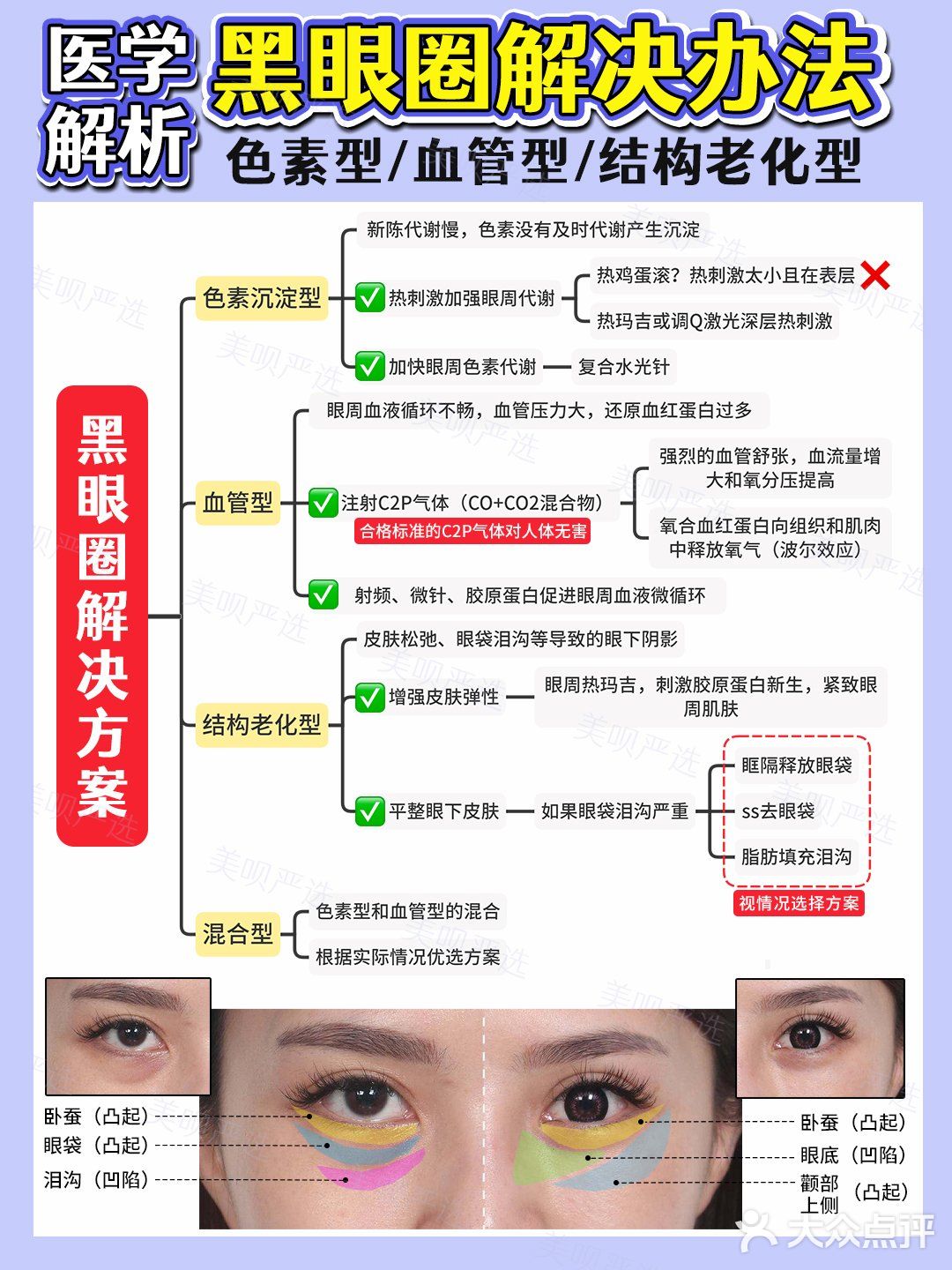 黑眼圈医学分析｜医美项目选择+眼霜成分草单