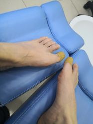 -德哥灰指甲脚气甲沟炎跖疣护理