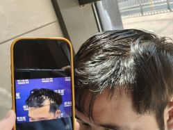 -碧莲盛·不剃发植发