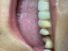 -上海仁爱医院口腔科 · 种植