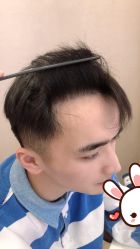 点击看大图 -大麦微针植发丨全国连锁