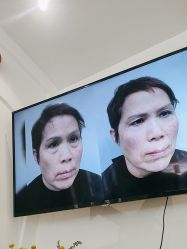 -广州健丽·去眼袋医疗美容机构