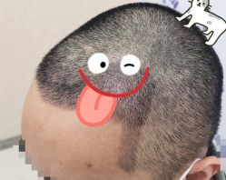 -大麦微针植发全国连锁