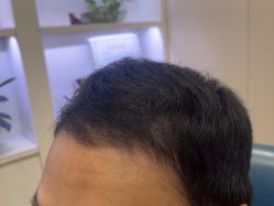 -大麦微针植发全国连锁