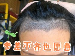 点击看大图 -碧莲盛·不剃发植发