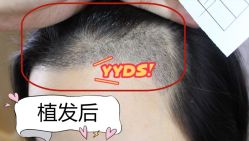 -大麦微针植发全国连锁