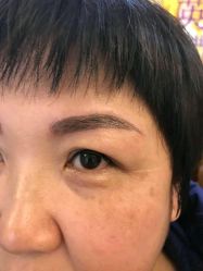 刚做完的效果-北京英煌医疗美容