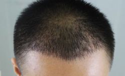 -大麦微针植发丨全国连锁