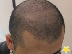 -大麦微针植发丨全国连锁