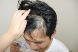 -大麦微针植发丨全国连锁