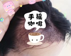 -大麦微针植发全国连锁